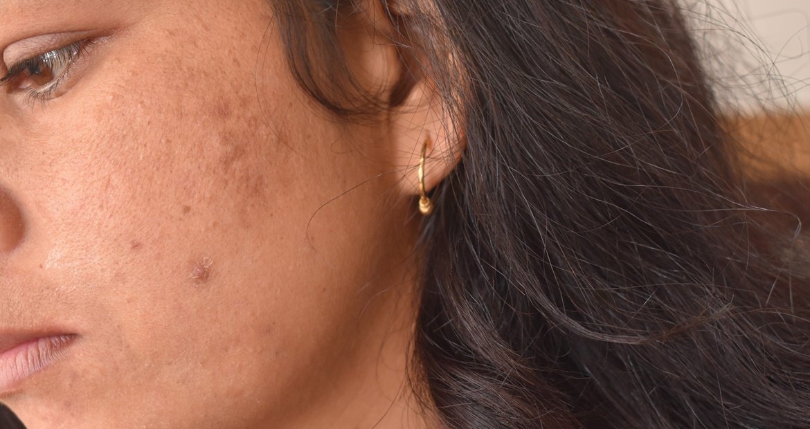 mulher branca com manchas escuras no rosto que podem ser tratadas com niacinamida